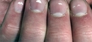 Tırnaktaki Beyaz Lekeler?