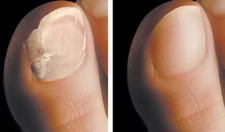 Ayak Tırnağının Kırılması Belirtileri ve Tedavisi