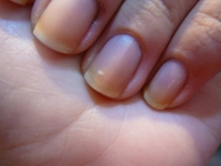 Tırnak Sararması Belirtileri ve Tedavisi