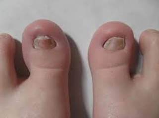 Bebeklerde Tırnak Mantarı Belirtileri ve Tedavisi