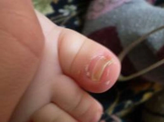 Çocuklarda Tırnak Mantarı Belirtileri ve Tedavisi