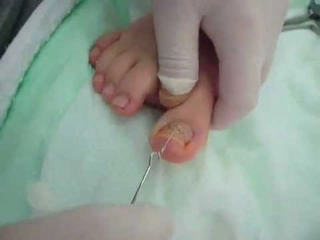 Tırnak Çekilmesi Belirtileri ve Tedavisi